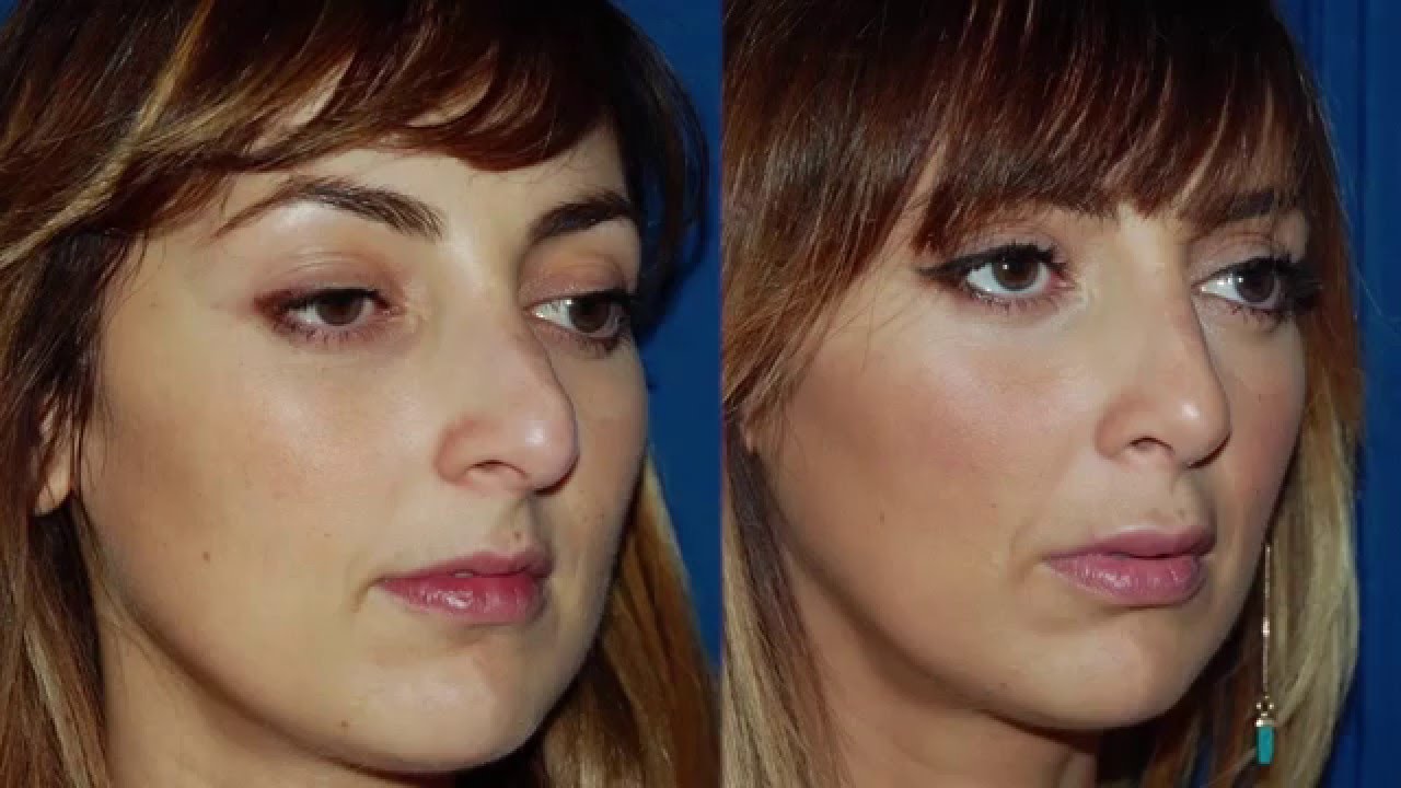 Rhinoplastie - Consultation de chirurgie esthétique avec le Dr Rajaonarivelo