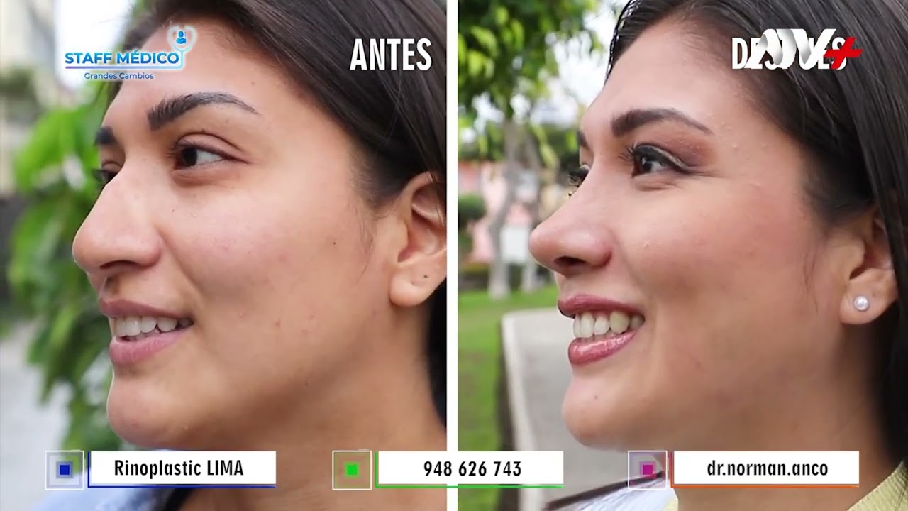 ✨#Rinoplastia Ultrasónica/ Dr. Norman Anco, cirujano plástico👨🏻‍⚕️