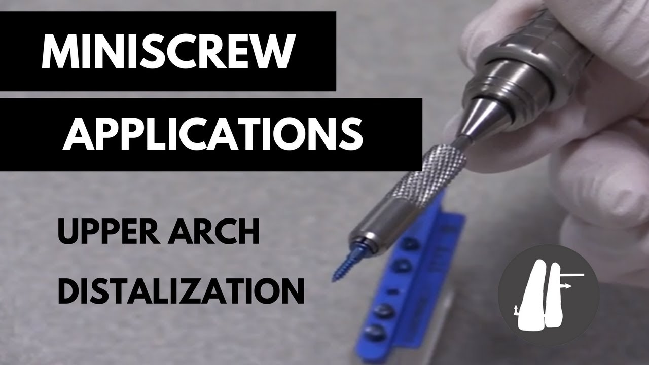 Miniscrew Applications: Upper Arch Distalization|Essential Biomechanics