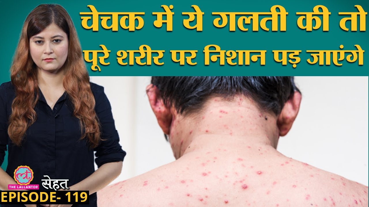 Chicken Pox जिसे माता निकलना कहते हैं, उसे लेकर बड़ी ग़लतफ़हमी दूर कर लीजिए | चेचक | Sehat ep 119
