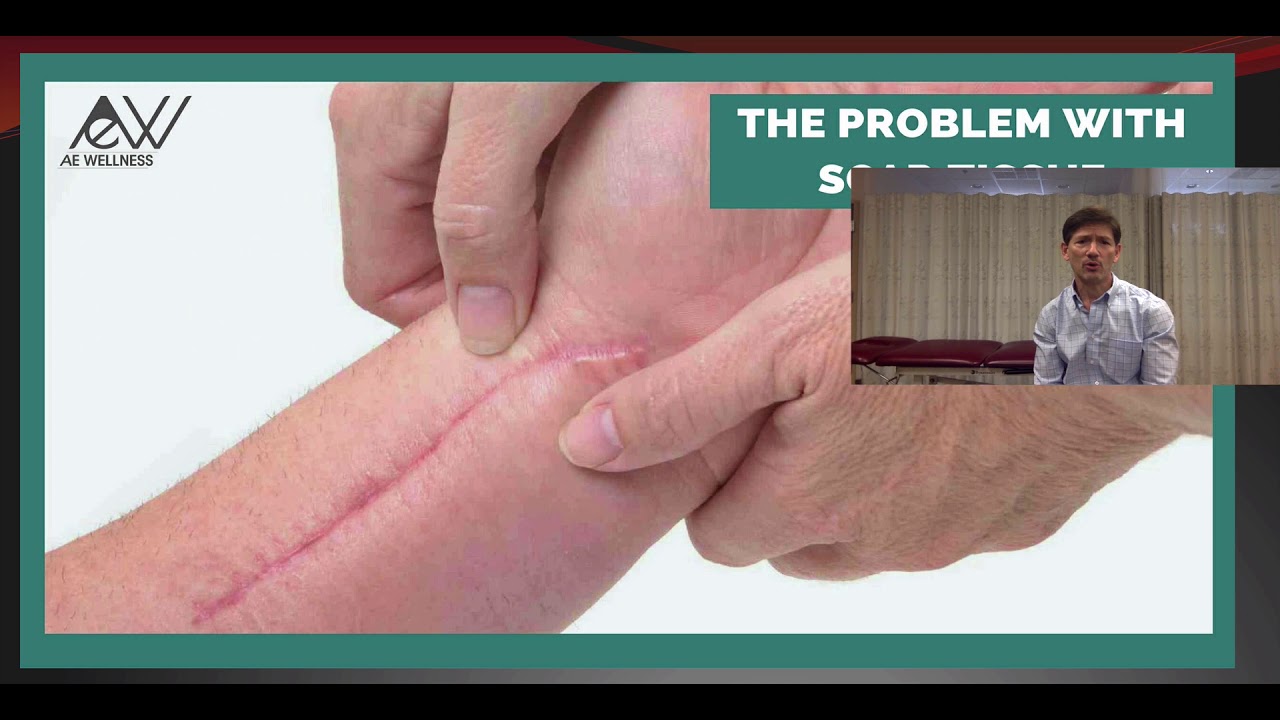 Scar Tissue Counterstrain Webinar