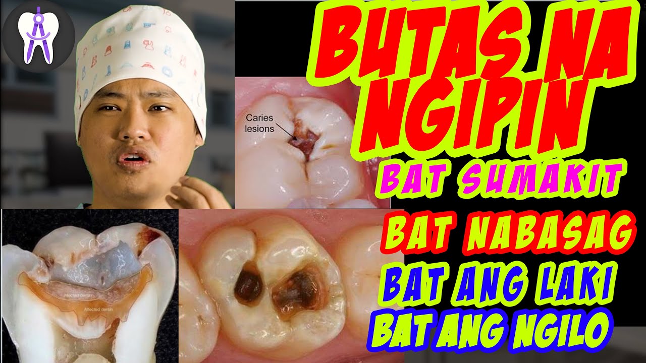 Paano Lumaki Ang Sira ng Ngipin.. At Mga Dapat Malaman Tunkol Dito(English subtitle) #48