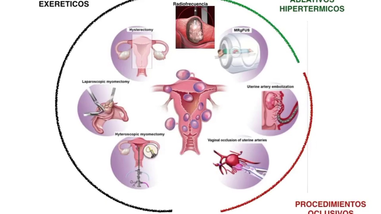 Tratamiento de radiofrecuencia en miomas uterinos - Dr. Pessadorrona