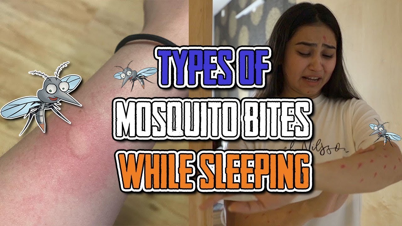 Types of mosquito bites while sleeping 4_IDIOTS