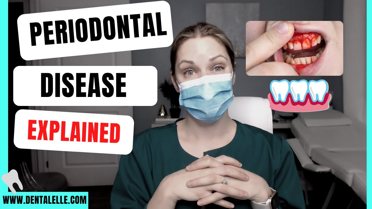 Periodontal Disease and the Pockets Explained