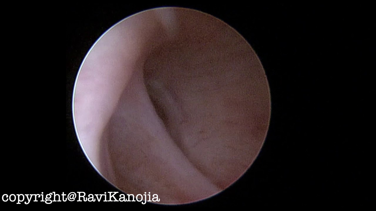 Anatomy of Anterior urethral valve