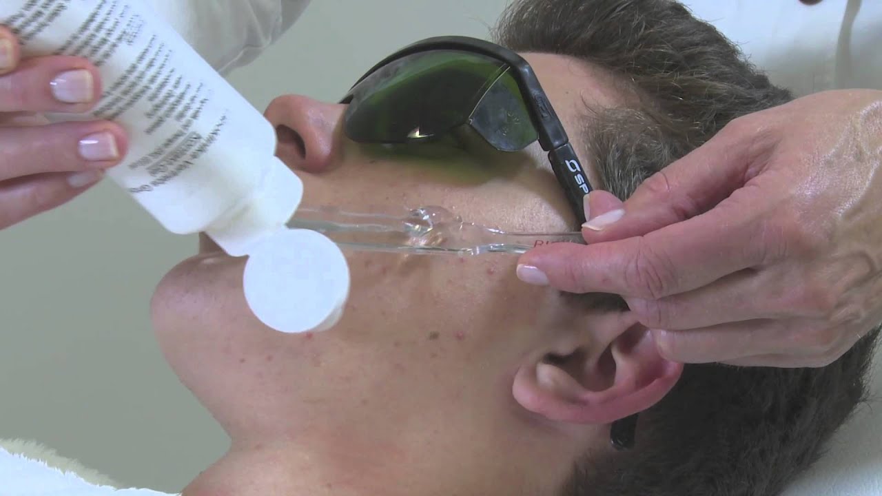 IPL Acne Clearing Treatment BIODROGA MD