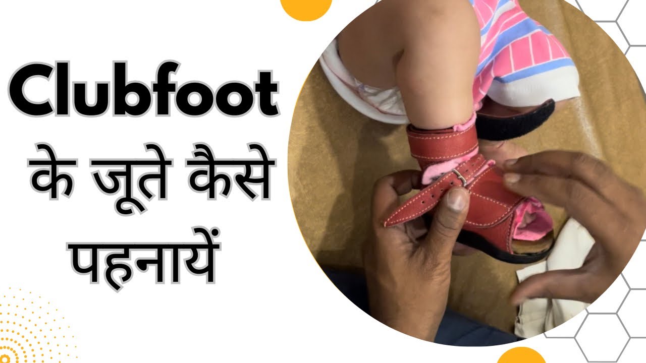 clubfoot के जूते कैसे पहनायें