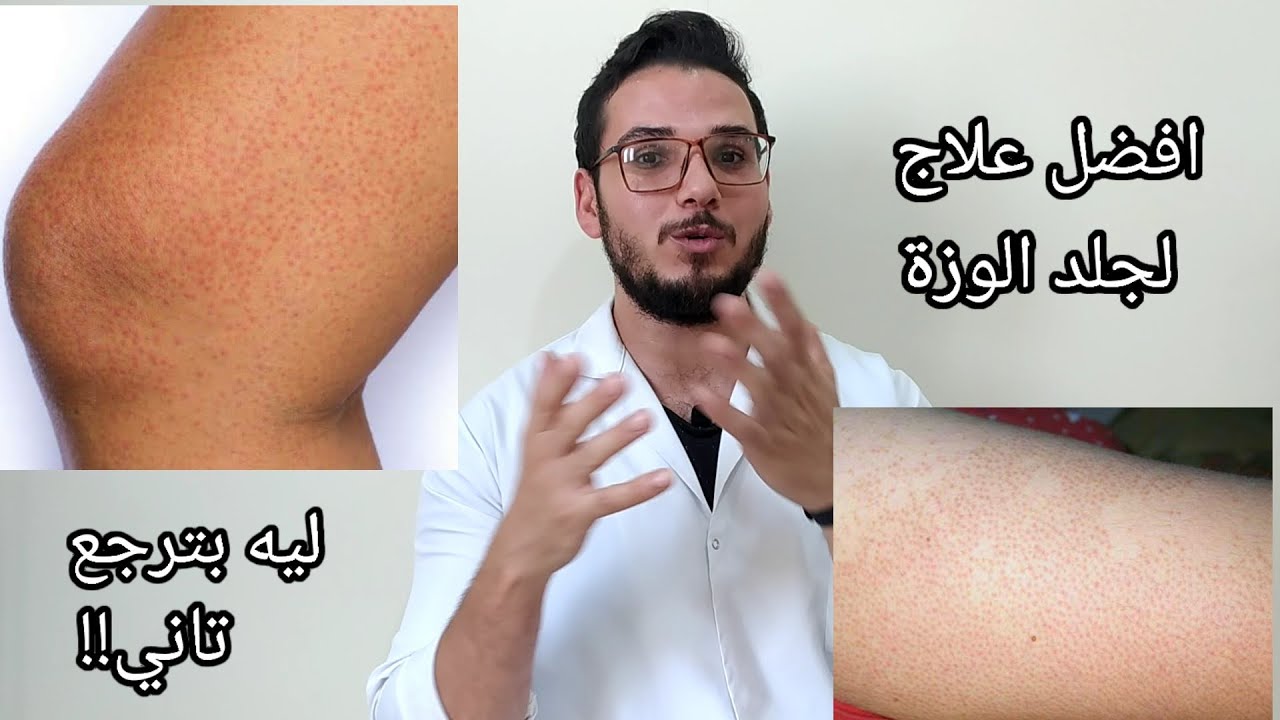 افضل علاج لجلد الوزة /ليه بترجع تاني؟؟