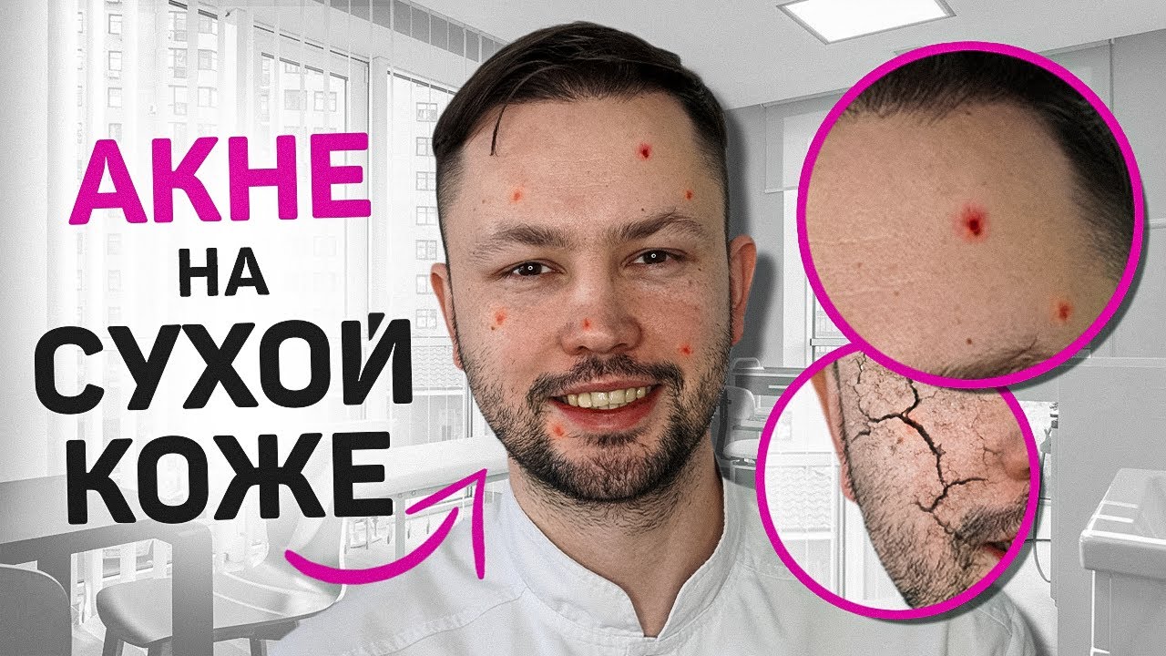 Почему АКНЕ на сухой коже? Что делать? Ответ врача
