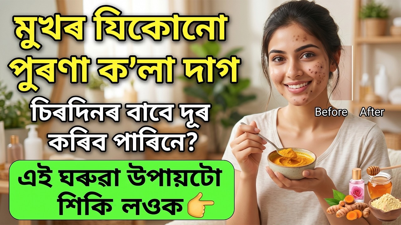 মুখৰ যিকোনো পুৰণা ক’লা দাগ চিৰদিনৰ বাবে দূৰ হ’ব | এই ঘৰুৱা উপায়টো শিকি লওক | Home Remedies
