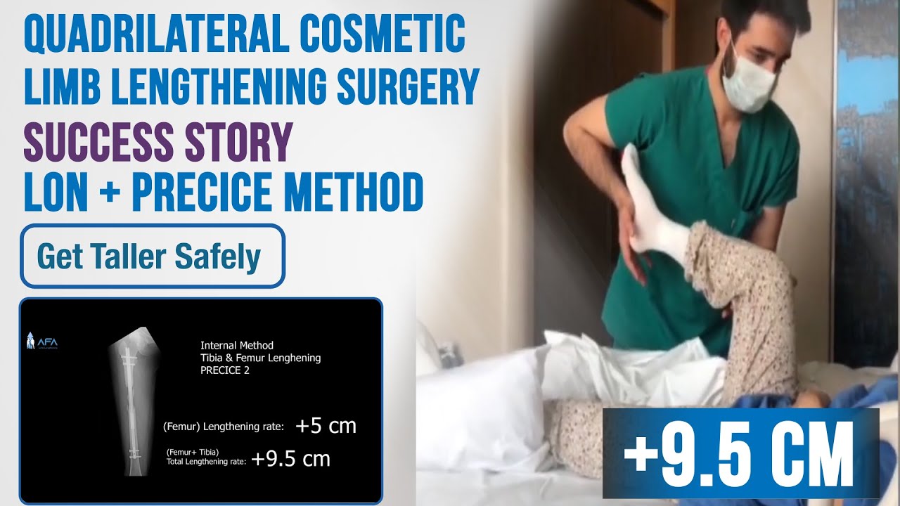 Quadrilateral Limb Lengthening Process with Precice 2 +9.5 cm