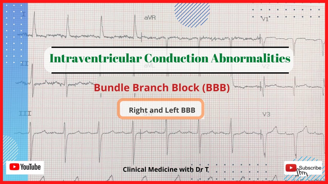 The ECG Series//Intraventricular Conduction Abnormalities//Bundle Branch Block//