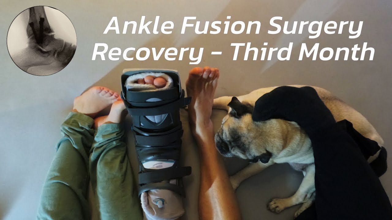 My Ankle Fusion Recovery - third month