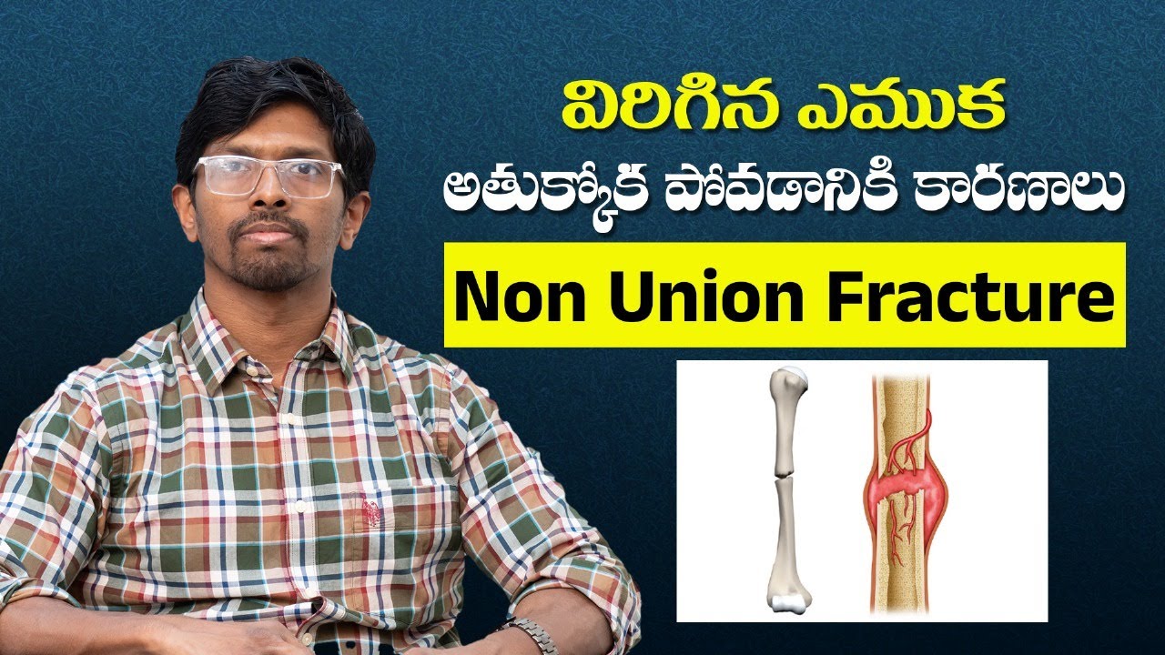 విరిగిన ఈమూక అత్తుకొక పోవడానికి కారణాలు || Reasons For Non Union Fracture in TELUGU || Dr. Vamshi