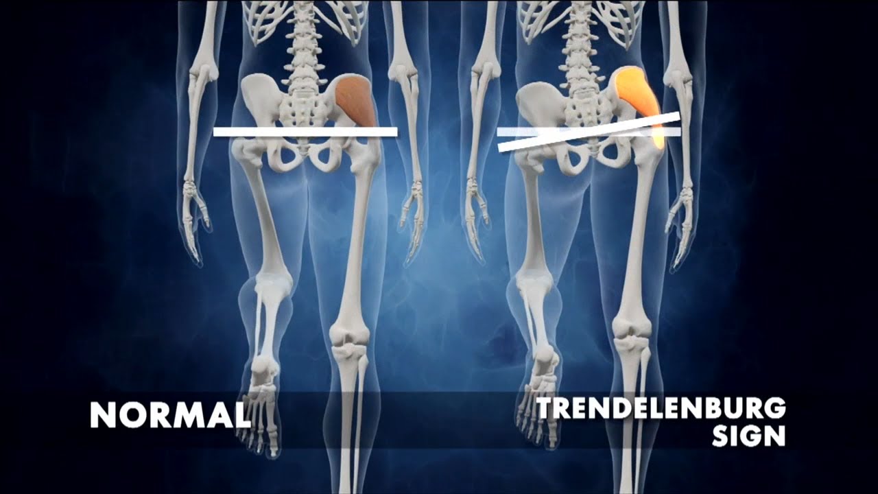 How to Tell if You Have Symptoms of Dead Butt Syndrome