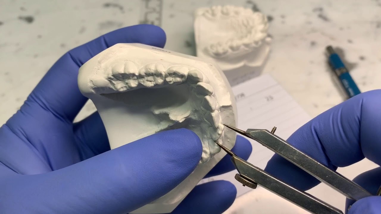 Análise de Moyers da dentição mista