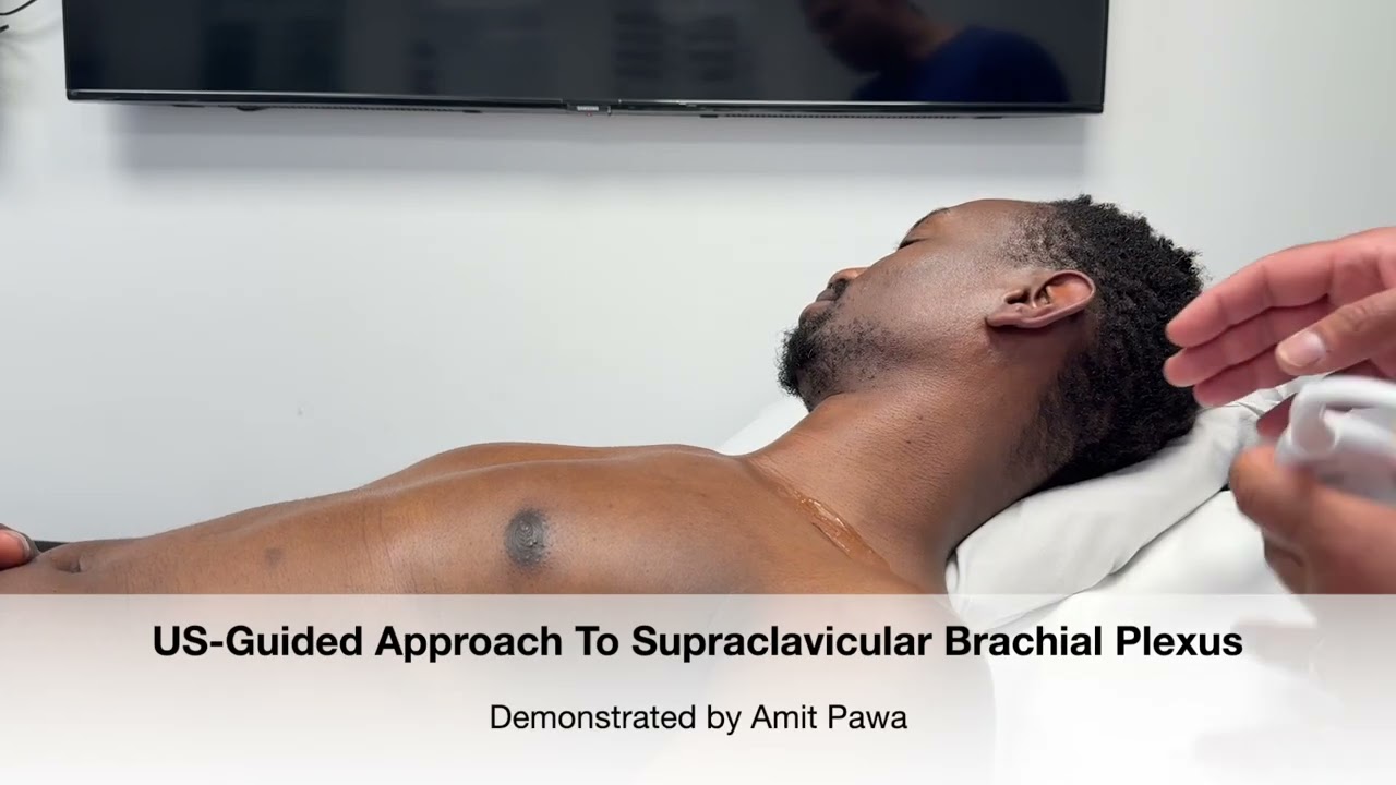 New Scanning Tutorial for Supraclavicular Brachial Plexus Block