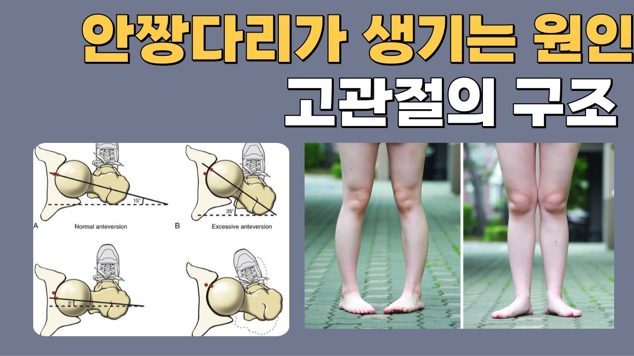 안짱다리가 생기는 원인을 고관절의 구조적인 이유로 설명해드려요!