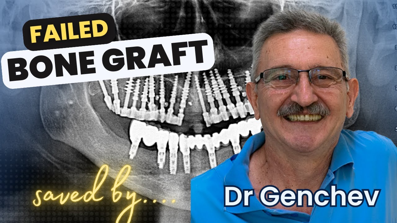 3 Failed Bone Grafts for Dental Implants - saved by Dr Genchev