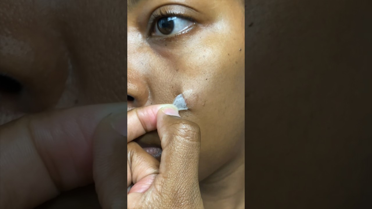let&rsquo;s peel this pimple patch together @theinkeylist784 🧪 #skincare #pimplepopping #acnetreatment