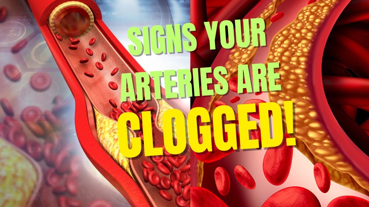 Warning Signs Your Arteries May Already Be Blocked!🚨 