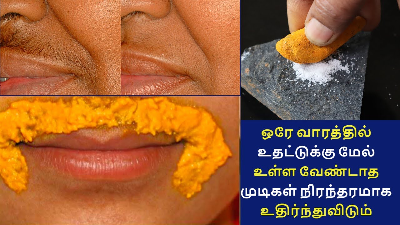 உதட்டுக்கு மேல் உள்ள முடி ஒரே வாரத்தில் நிரந்தரமாக உதிர இதை போட்டால் போதும் | upper lip hair removal