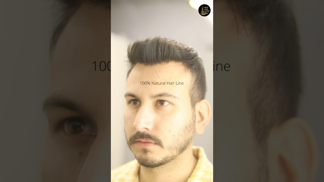 Hair patches for men: Undetectable Front hair line by New Hair Image