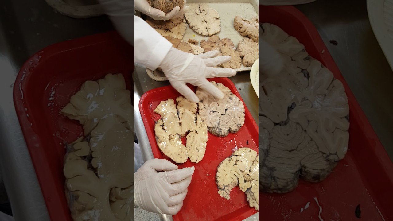 Neuroanatomía: anatomía interna de los hemisferios cerebrales
