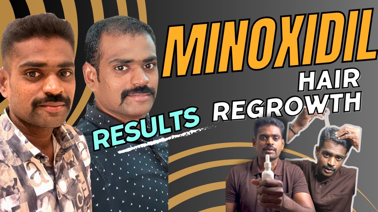 Minoxidil hair regrowth results | Side effects of minoxidil from personal experience #hair #haircare