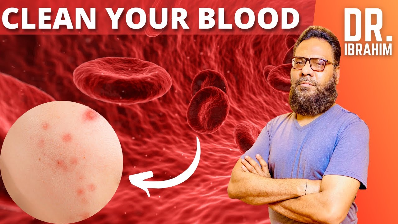 Khoon Saaf Karne Ka Tariqa | How To Clean Your Blood | Painful Pimples Outspread | Dr. Ibrahim