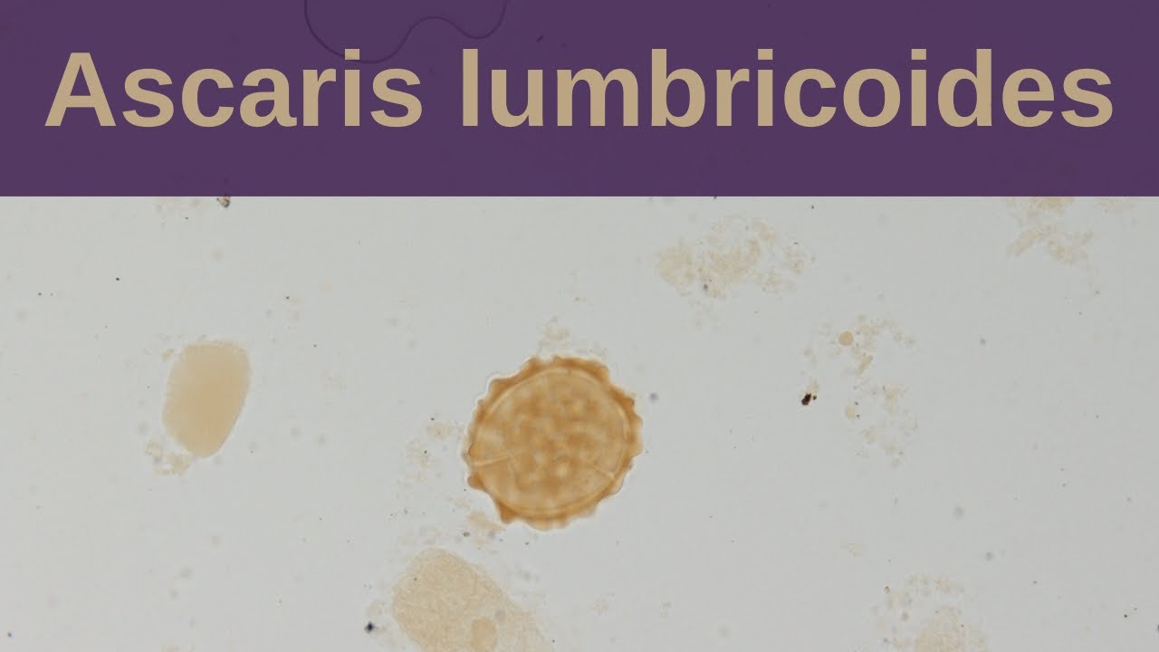 Ascaris Lumbricoides and Ascariasis - Pathology mini tutorial