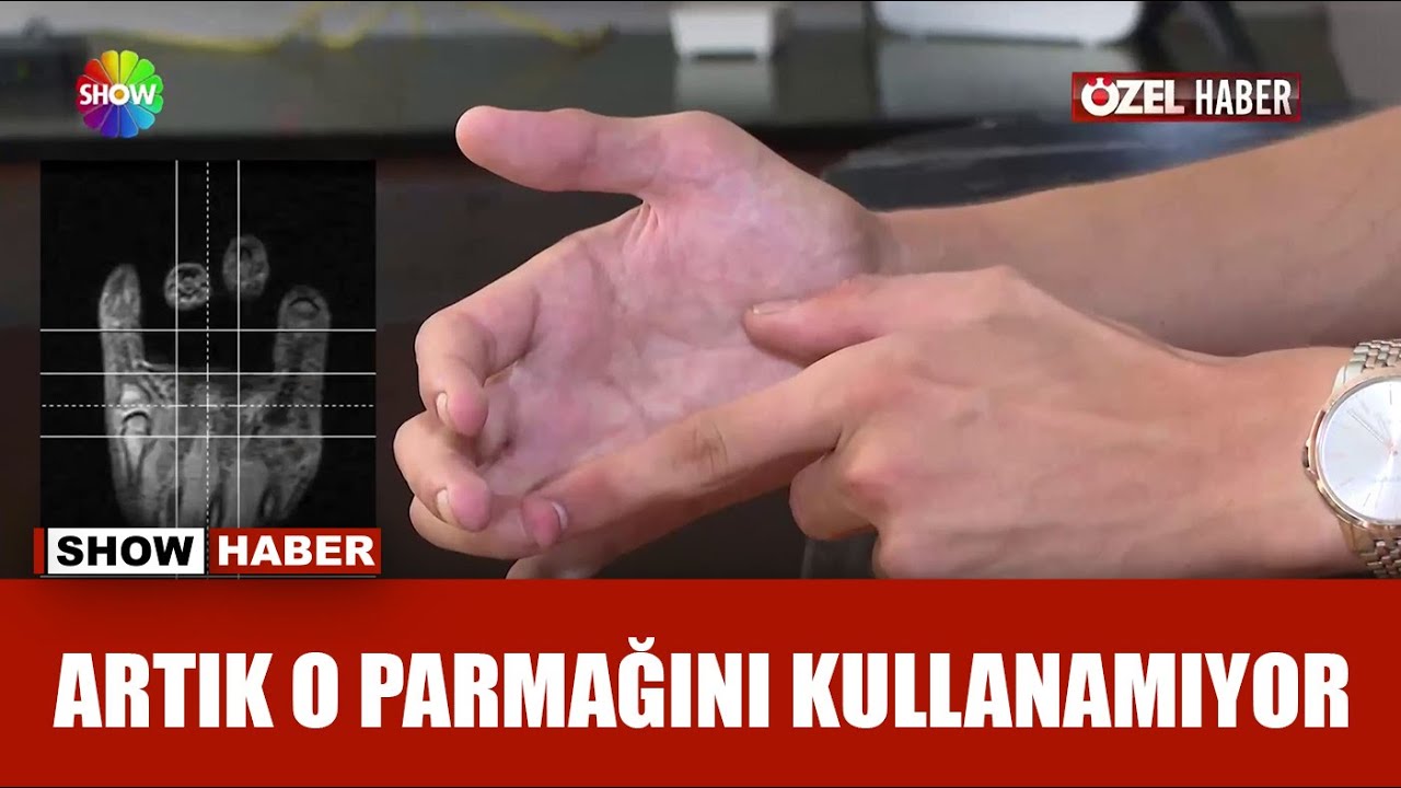 Kırık iyileşti, sağlam parmağı sakat kaldı