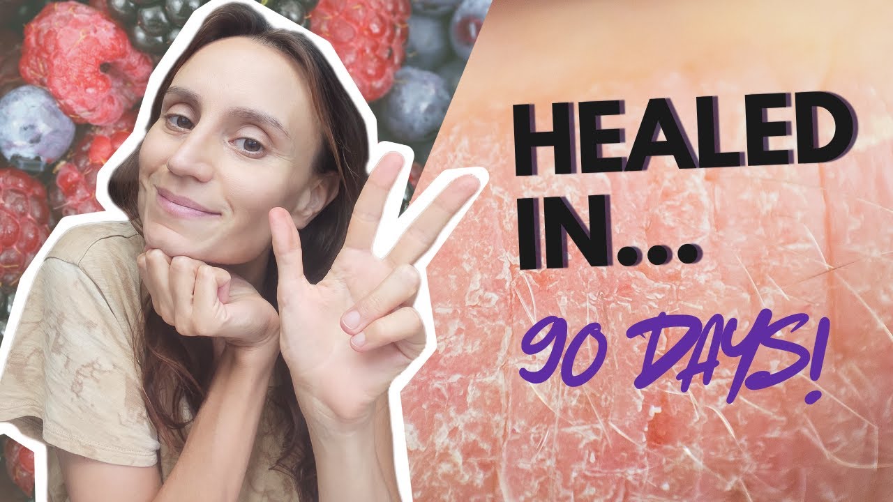 TOP 3 Healing Foods for Eczema (Have Them Daily + For Breakfast)