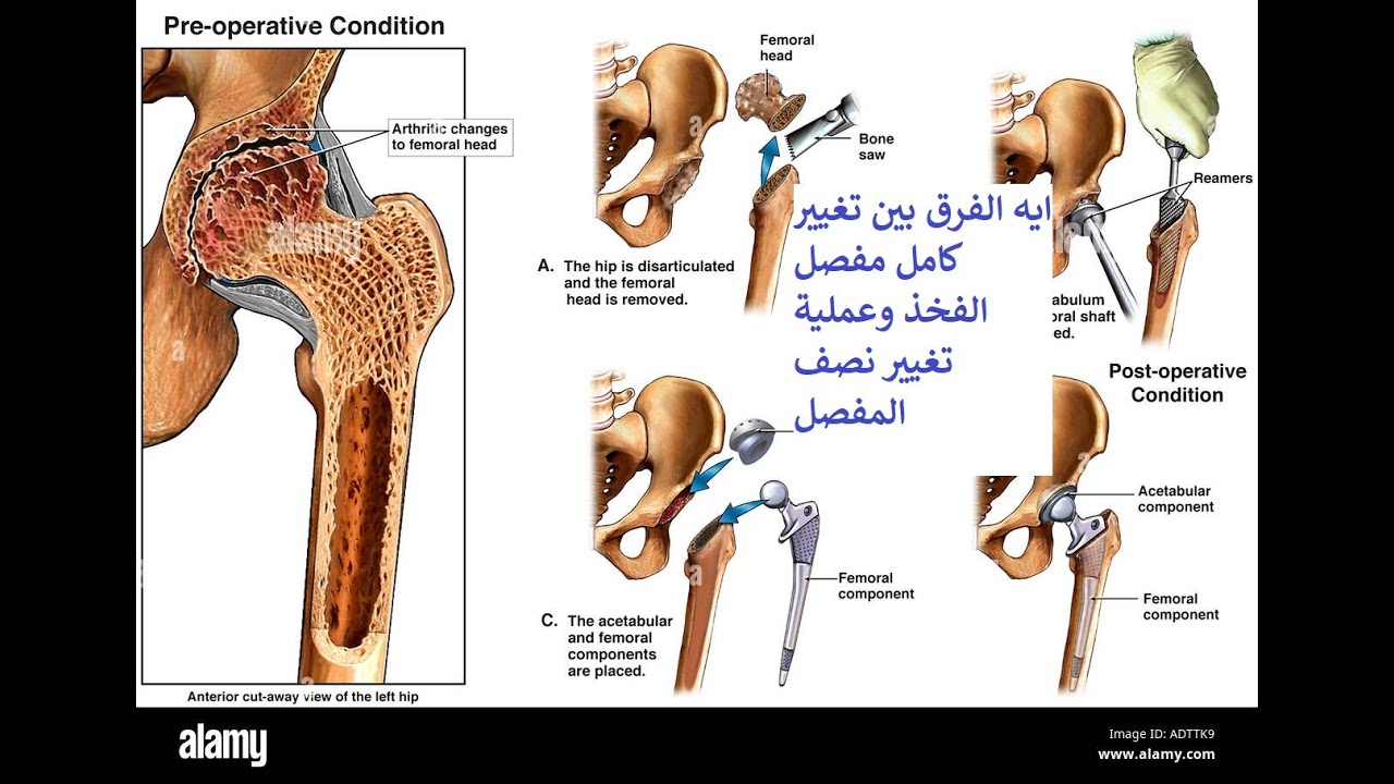 يعني ايه ؟تغيير مفصل كامل ؟تغيير نصف المفصلhemiarhroplasty versus  total hip arthroplasty