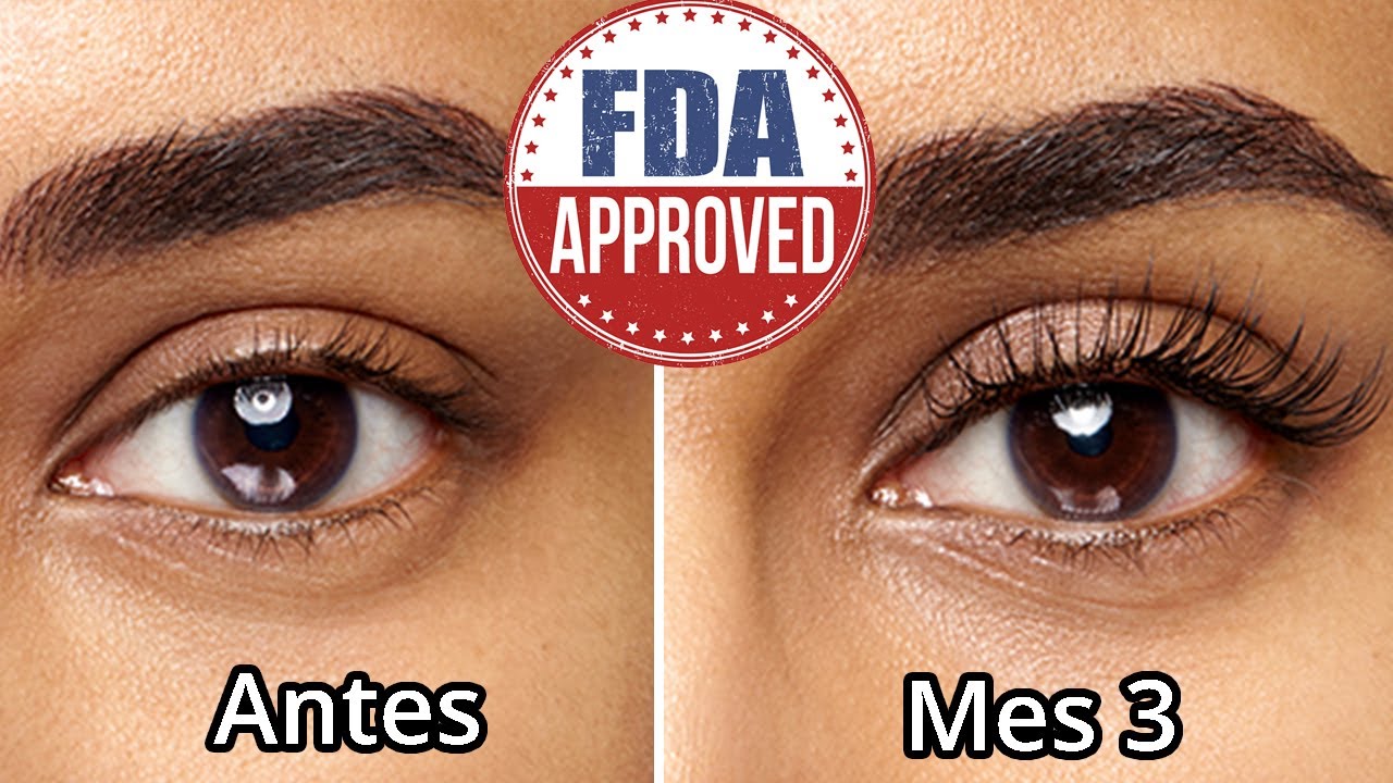 Bimatoprost Para Pestañas, Cejas Y Alopecia