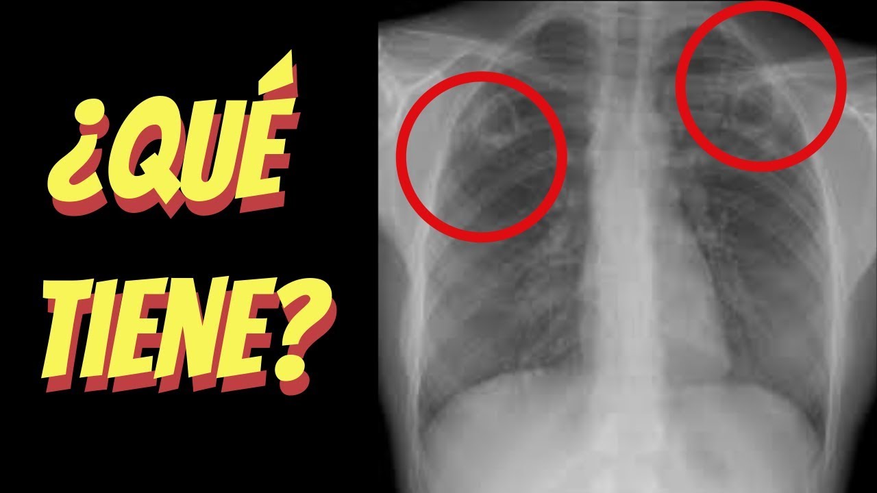 5 casos clínicos de radiografía de tórax