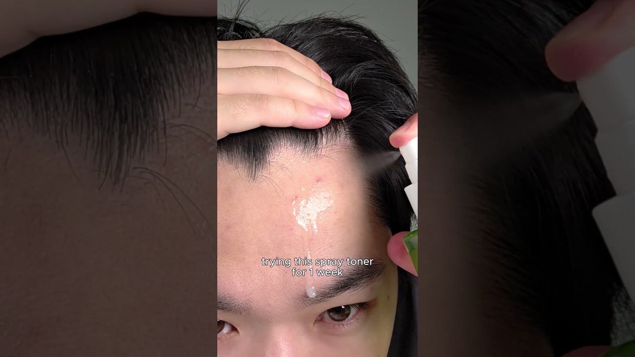 spray toner for acne treatment  #skincare #kskincare #kbeauty #acne #acnetreatment #toner #orien