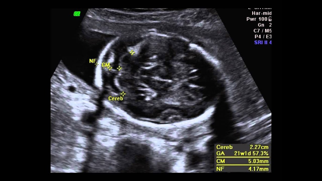 Fetal Anatomic Survey