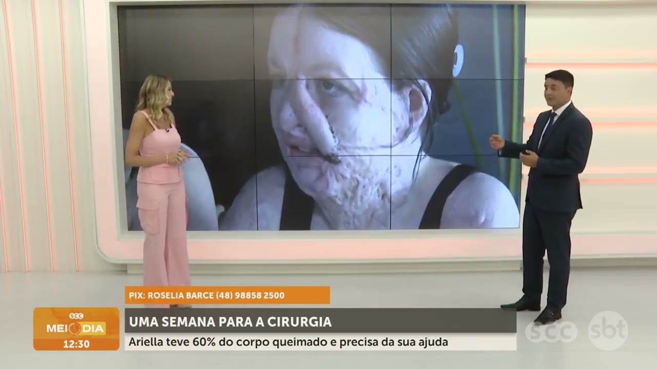 Uma semana para cirurgia de Ariella que teve 60% do corpo queimado | Cotidiano | SCC Meio-Dia