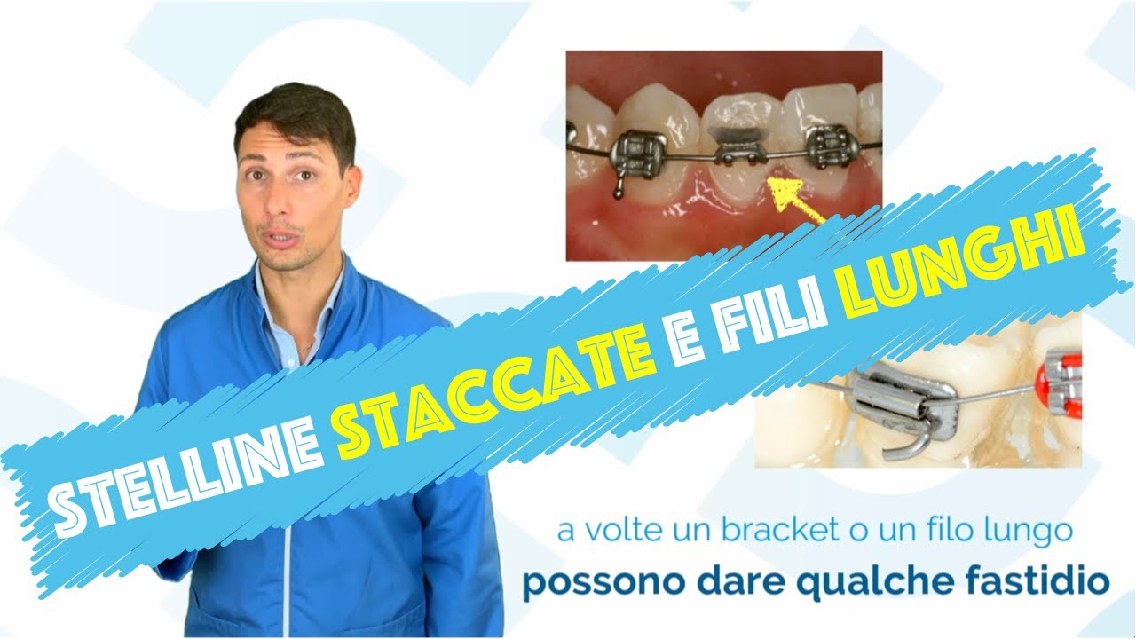Come fare con stelline staccate o fili lunghi che pungono (apparecchio con i brackets)