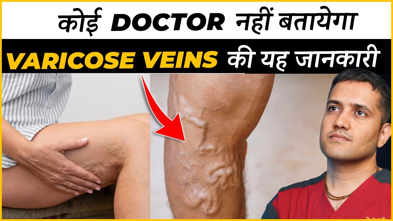Real Information About Varicose Veins Treatment That No Doctor Will Tell You | Dr. Gaurav (IR)