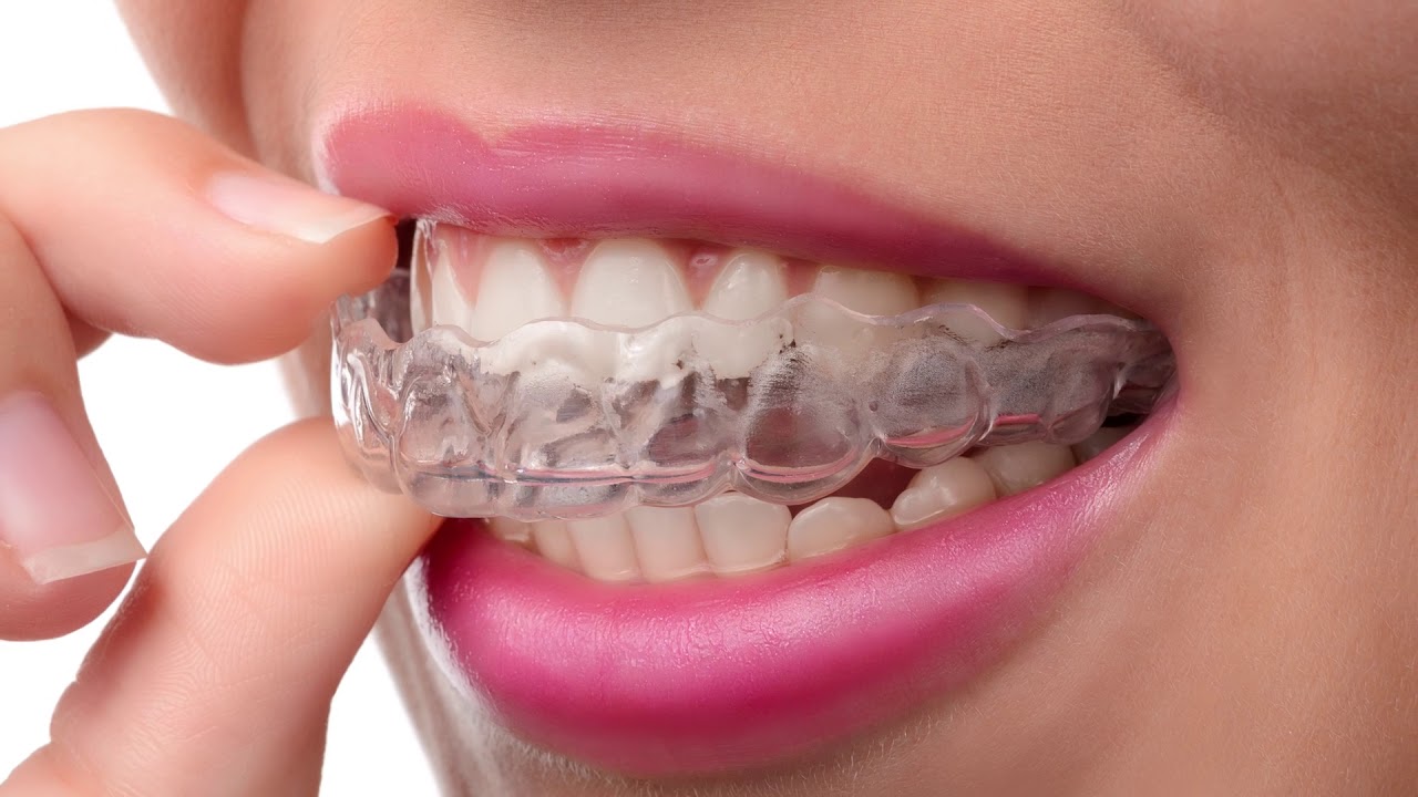FAQ - How does Invisalign work? | Dr. Ron Richardson | Melbourne Invisalign