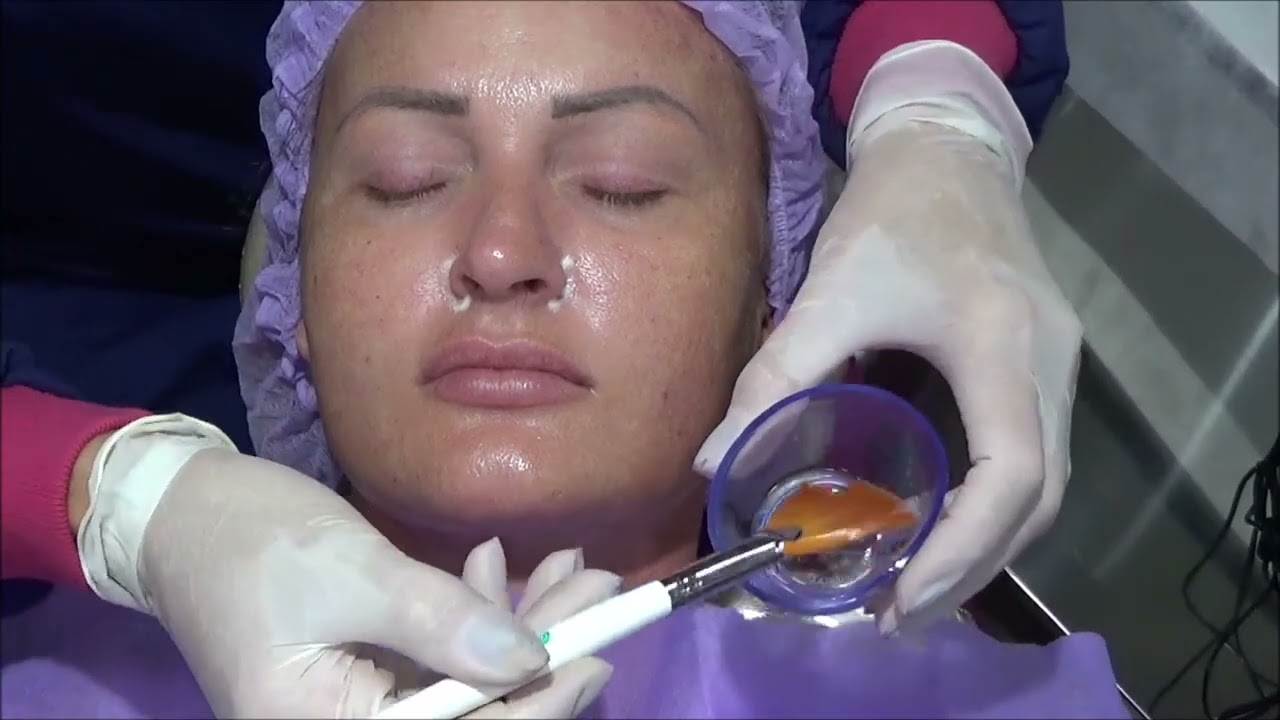 Peeling Tricloroacetico - ATA