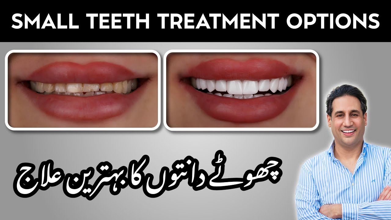 Small Teeth Treatment Options | Short Teeth Problem | Best Dentist in Pakistan | Dr. Shahzad Mirza