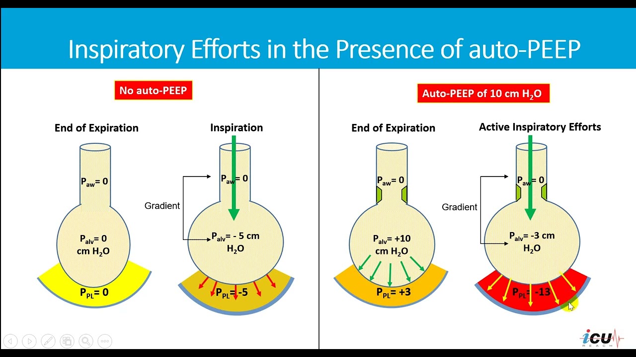 Adding Extrinsic PEEP in Dynamic Hyperinflation Syndrome