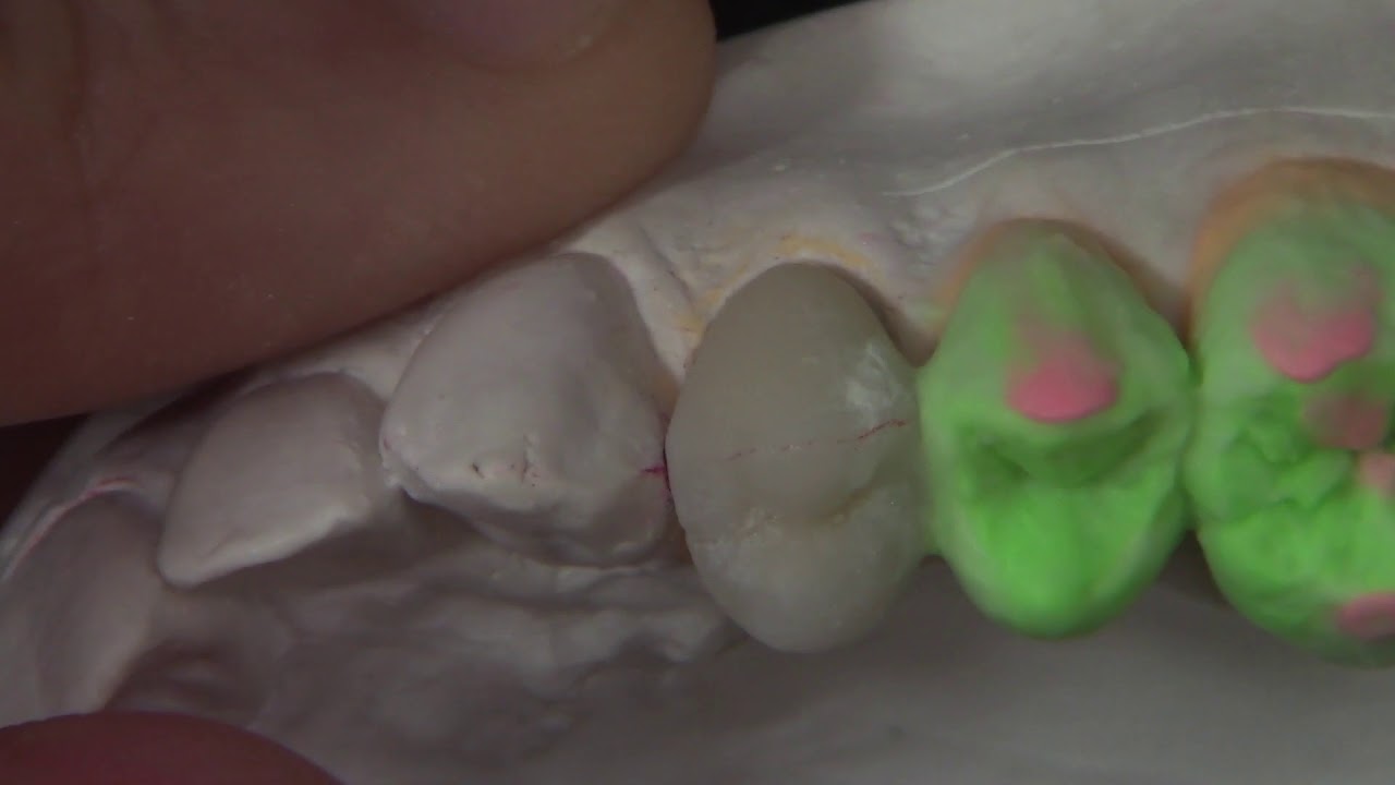 Lab Fordent | Metalocerâmica Vita VMK Master | TPD Gustavo Reis