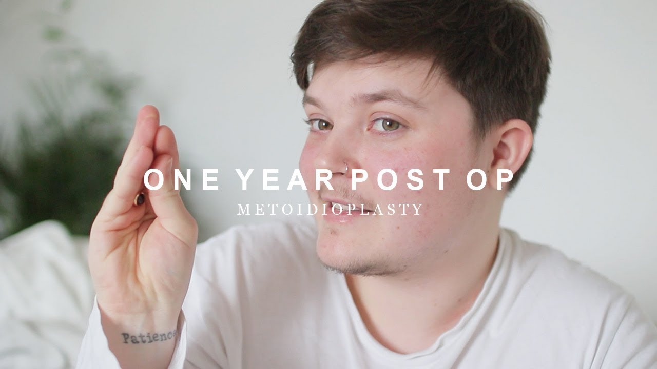 One Year Post Metoidioplasty | FTM