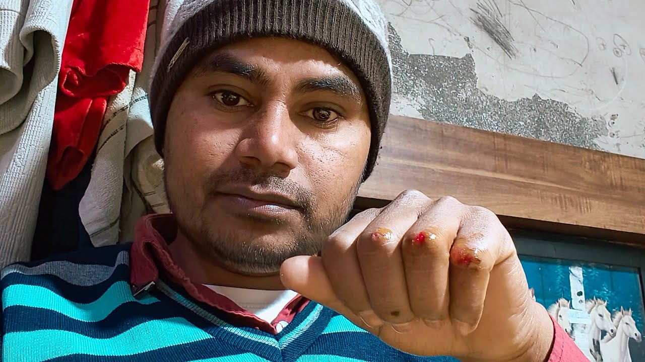 मेरे हाथ पर लगी चोट 😢