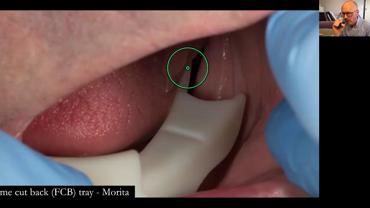 Webinar on Complete Dentures for dental students by Finlay Sutton and Sam Hesketh - during Covid